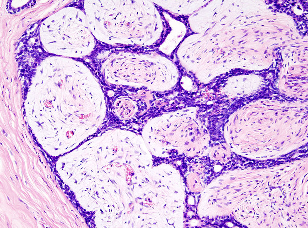 Manejo y Tratamiento de Fibroadenomas