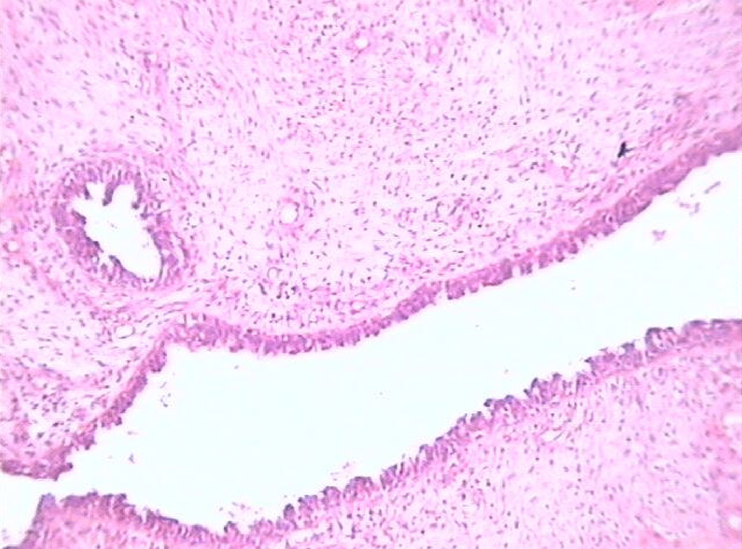 Tumor Phyllodes