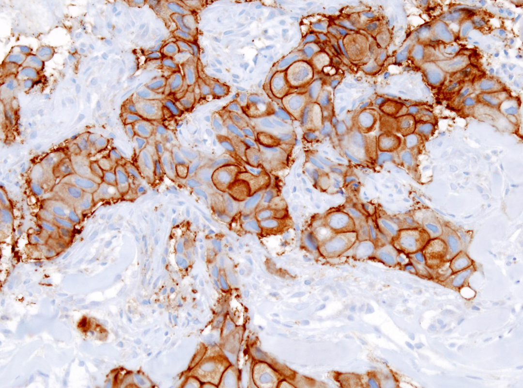 Carcinoma Ductal
