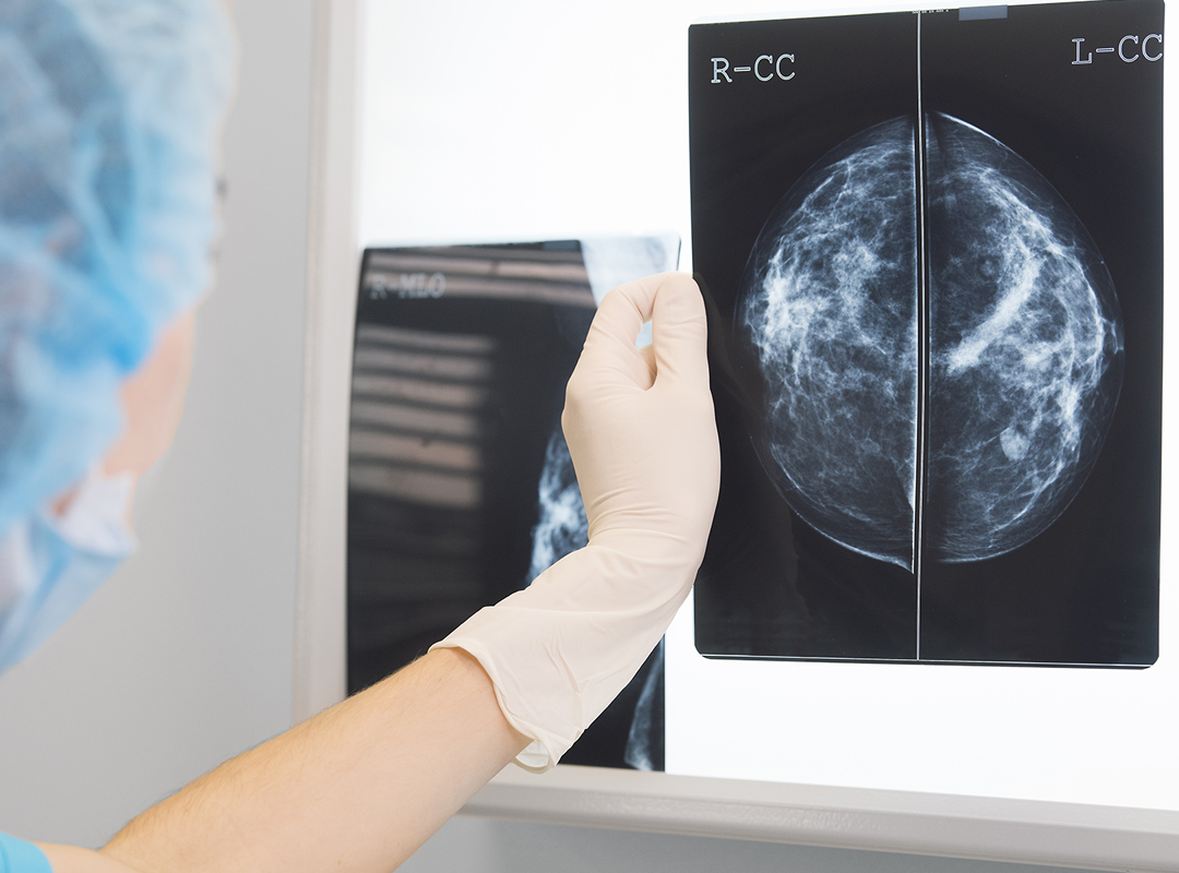 Tipos de cáncer de mama: lo esencial