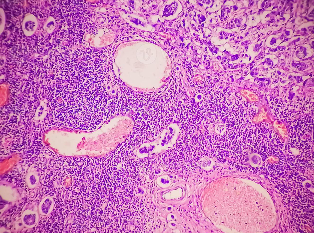 Carcinoma